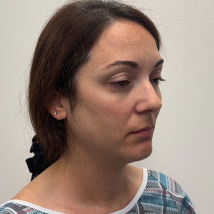 Rhinoplasty Before & After Patient #12095