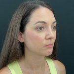 Rhinoplasty Before & After Patient #12095