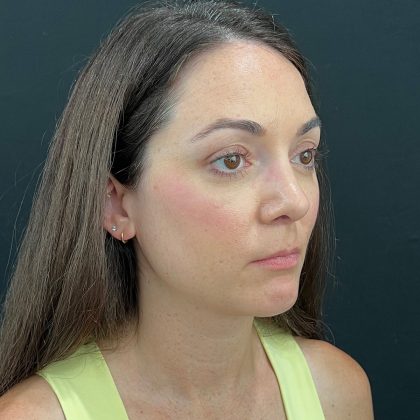 Rhinoplasty Before & After Patient #12095