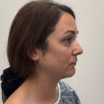 Rhinoplasty Before & After Patient #12095