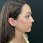 Rhinoplasty Before & After Patient #12095