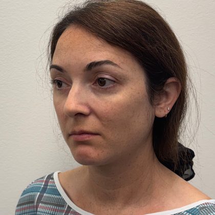 Rhinoplasty Before & After Patient #12095