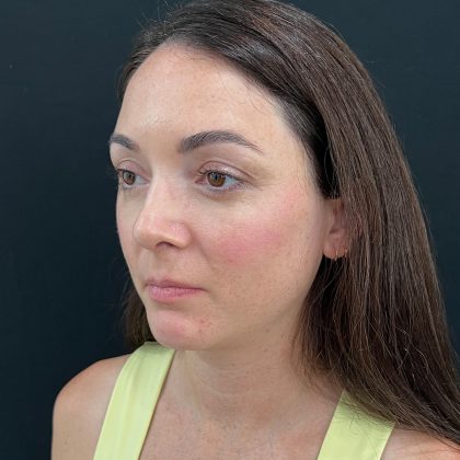 Rhinoplasty Before & After Patient #12095