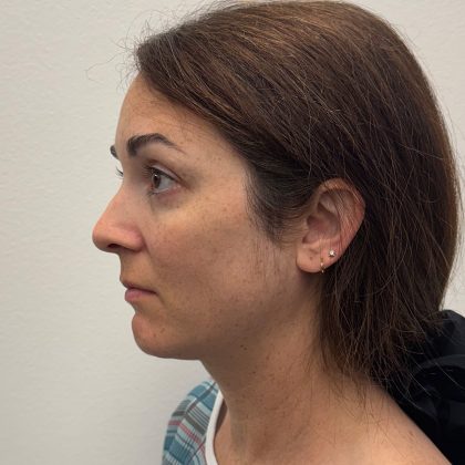 Rhinoplasty Before & After Patient #12095