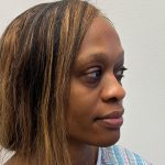 Rhinoplasty Before & After Patient #12206