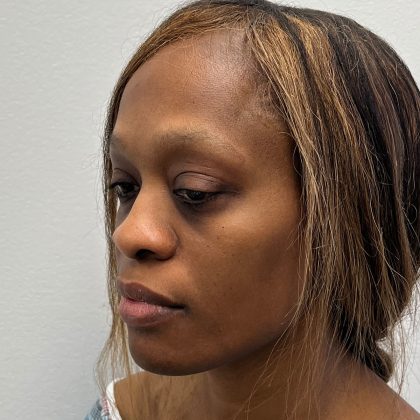 Rhinoplasty Before & After Patient #12206