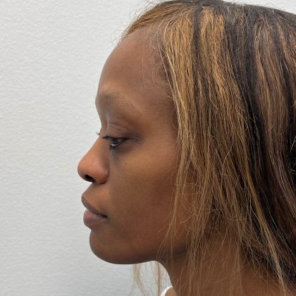 Rhinoplasty Before & After Patient #12206